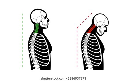 Diagram of deformation of the cervical vertebrae. Neck spasm, pain in spine, stiffness and tightness in shoulders. Healthy spine and hump in male body medical vector illustration, skeleton silhouette.