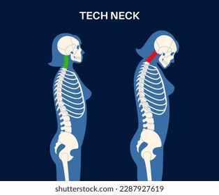 Diagram of deformation of the cervical vertebrae. Neck spasm, pain in spine, stiffness and tightness in shoulders. Healthy spine and hump in male body medical vector illustration, skeleton silhouette.