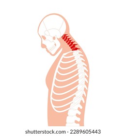 Diagram of deformation of the cervical vertebrae. Neck spasm, pain in spine, stiffness and tightness in shoulders. Healthy spine and hump in male body medical vector illustration, skeleton silhouette.