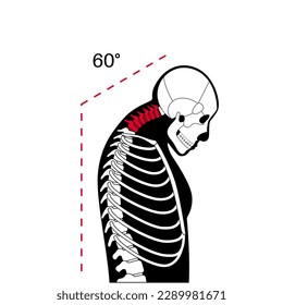 Diagram of deformation of the cervical vertebrae. Neck spasm, pain in spine, stiffness and tightness in shoulders. Healthy spine and hump in male body medical vector illustration, skeleton silhouette.