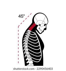 Diagram of deformation of the cervical vertebrae. Neck spasm, pain in spine, stiffness and tightness in shoulders. Healthy spine and hump in male body medical vector illustration, skeleton silhouette.