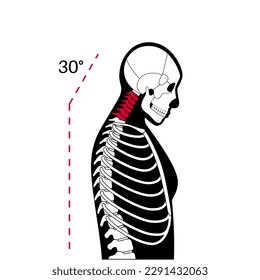 Diagram of deformation of the cervical vertebrae. Neck spasm, pain in spine, stiffness and tightness in shoulders. Healthy spine and hump in male body medical vector illustration, skeleton silhouette.