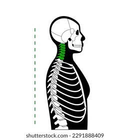 Diagram of deformation of the cervical vertebrae. Neck spasm, pain in spine, stiffness and tightness in shoulders. Healthy spine and hump in male body medical vector illustration, skeleton silhouette.