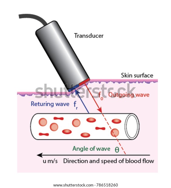 Diagram of Doppler blood flow measurement, showing the transducer on ...