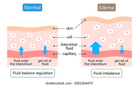 diagram of Edema and normal skin. swelling is caused by excess fluid within the tissues of the body. Before after illustration. Health care concept