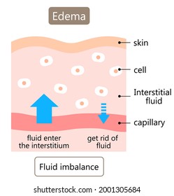 Diagram Of Edema Skin Illustration.   Swelling Is Caused By Excess Fluid Within The Tissues Of The Body. Health Care Concept