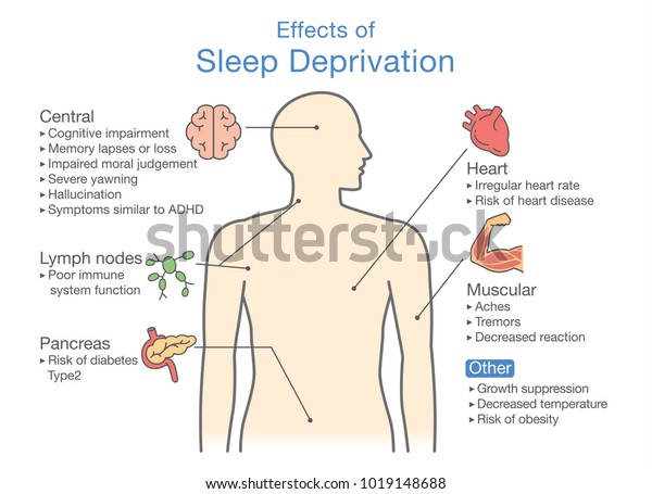 睡眠不足の影響の図 疾患の診断に関する図 のベクター画像素材 ロイヤリティフリー