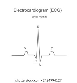 The diagram of Electrocardiogram (ECG) or Electrocardiography (EKG) that reads is a typical sinus rhythm.