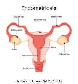 Diagram of endometriosis clinical features