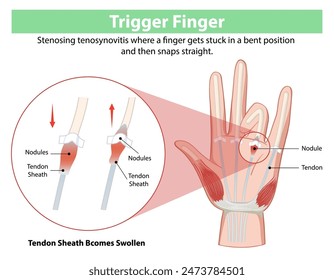 Diagram explaining trigger finger condition