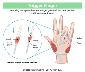 Diagramm zur Erklärung der Erkrankung des Triggerfingers