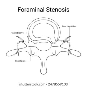 Diagram of foraminal stenosis medical design in line style