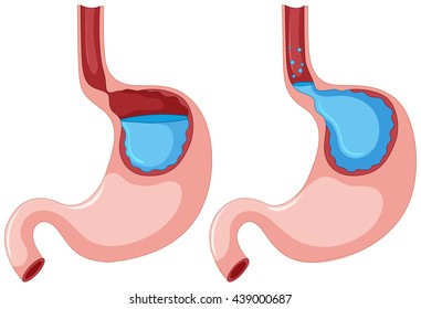 Diagram Of Gastroesophageal Reflux Disease Illustration