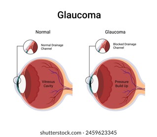 Diagram of glaucoma affected human eye and normal eye