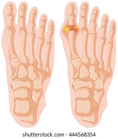 2,327 Gout foot Images, Stock Photos & Vectors | Shutterstock