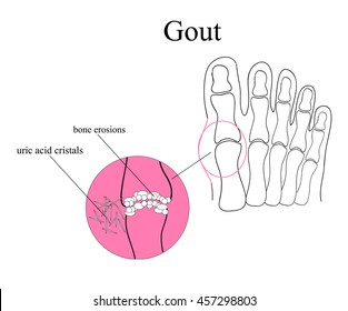 Diagram of gout in human toe illustration