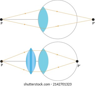 Diagrama de cómo un ojo con un defecto visual llamado hiperopía compone imágenes