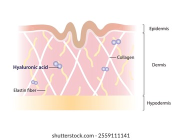 Diagram of Hyaluronic acid decrease in dermis layer vector illustration on white background. Cross section of aging skin with small amounts of shorter hyaluronic acid. Skin care and beauty concept.