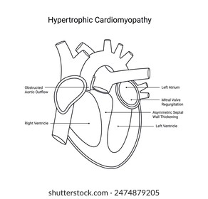 Diagrama de la enfermedad miocardiopática hipertrófica en línea