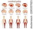 cerebral palsy brain