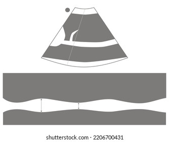 Diagram of Inferior Vena Cava Ultrasound in M Mode