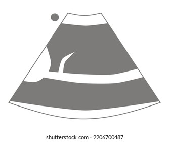 Diagram of Inferior Vena Cava Ultrasound