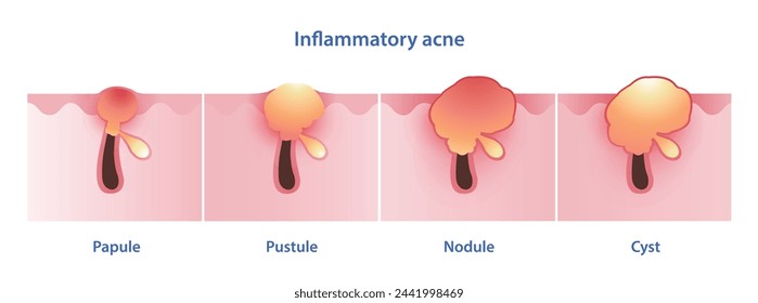 Diagram of inflammatory acne types vector illustration isolated on white background. Papule, pustule, nodule, nodular, nodulocystic, cystic acne and cyst. Skin care and beauty concept.