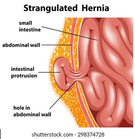 Diagram of inside strangulated hernia