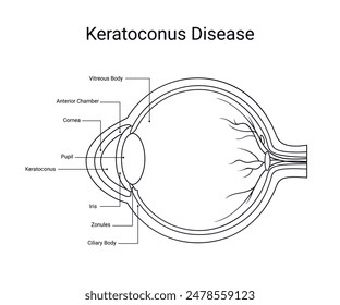 Diagrama del diseño médico de la enfermedad del queratocono con estilo de línea