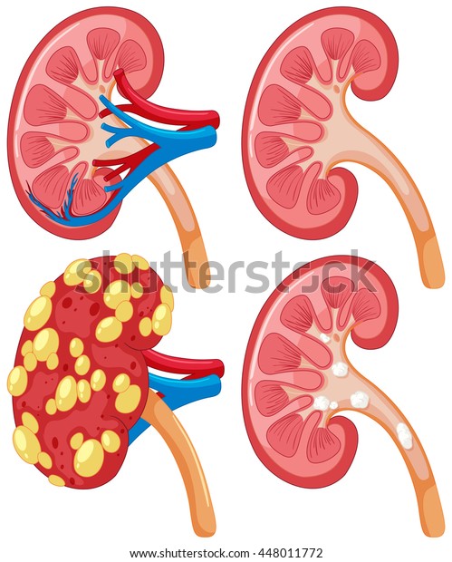 Diagram Kidney Disease Illustration Stock Vector (Royalty Free) 448011772