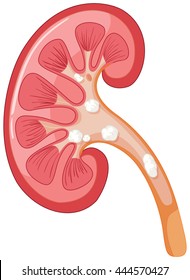 Diagram of kidney having problem  illustration