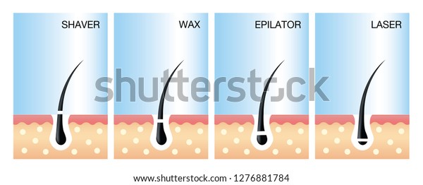 Diagram Laser Hair Removallaser Hair Removal Stock Vector Royalty