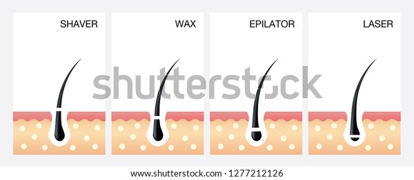 Diagram Laser Hair Removallaser Hair Removal Stock Vector Royalty