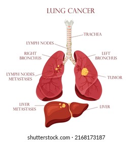 1,893 Lung metastasis Images, Stock Photos & Vectors | Shutterstock