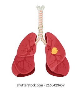 Diagram lung cancer disease. Concept disease human internal organs. Vector illustration, cartoon style.