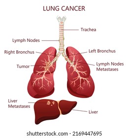 Diagram lung cancer disease. Concept disease human internal organs. Vector illustration, cartoon style.