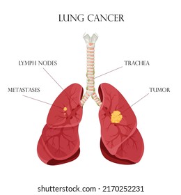 Diagram Lung Cancer Disease Concept Disease Stock Vector (Royalty Free ...