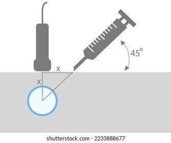 Diagram of Method of Ultrasound Guided Central Venous Catheter Insertion