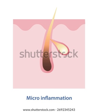 Diagram of micro inflammation within pore vector illustration. Acne cycle caused by small, blocked pores, microcomedones breakdown, inflammation occurs beneath the skin surface. Skin anatomy concept.