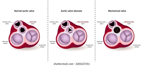 Diagram Of Normal, Aortic Valve Stenosis And Mechanical Valve. Aortic Valve Repair. Aortic Valve Replacement.