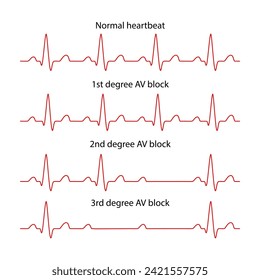 Diagram of normal rhythm and AV block for a human heart. Heart cardiogram. Vector illustration in flat style isolated on white background