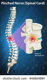 Diagram Pinched Nerve Spinal Cord Illustration Stock Vector (Royalty ...