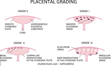 Diagram Of Placental Grading. Four Grades From 0 To III. Shows How Differ Chorionic Plate And Placental Substance Due To The Term Of Pregnancy. Medical Vector Illustration Isolated On White.