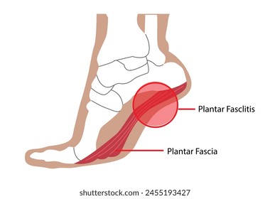 Diagrama de fascitis plantar causando dolor infernal. Arte de Clip editable