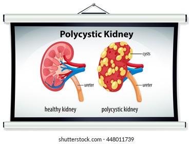 Diagram of polycystic kidney illustration