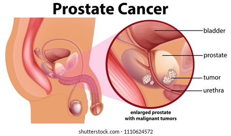 Diagram Of Prostate Cancer Illustration