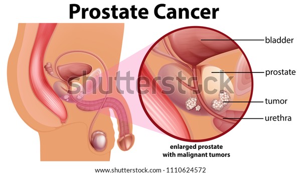 Diagram of prostate\
cancer illustration