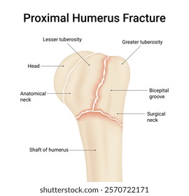 Diagram of Proximal Humerus Fracture