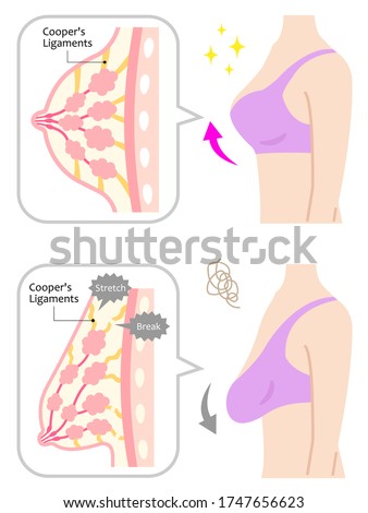 diagram of sagging and beautiful breasts with woman’s upper body. Beauty body care concept