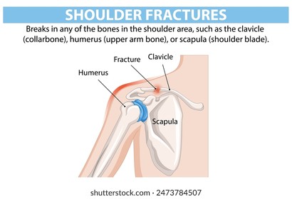 Diagrama de huesos del hombro y localización de fracturas